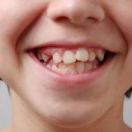 تشخیص دندان نیش نهفته چگونه است ؟