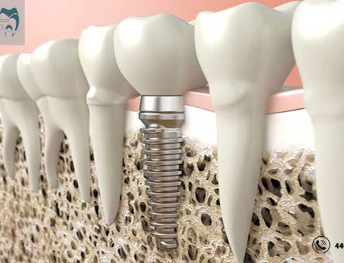 پوکی استخوان فک چه تاثیری در سلامت دندان ها دارد ؟