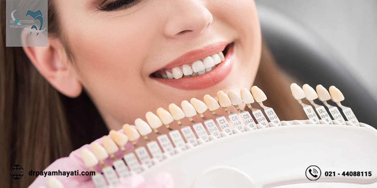 روش های جلوگیری از تغییر رنگ دندان کامپوزیت