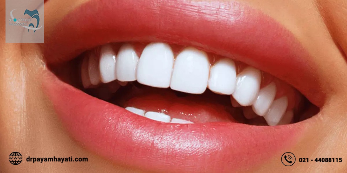 عوامل موثر در قیمت لمینیت دندان چیست ؟