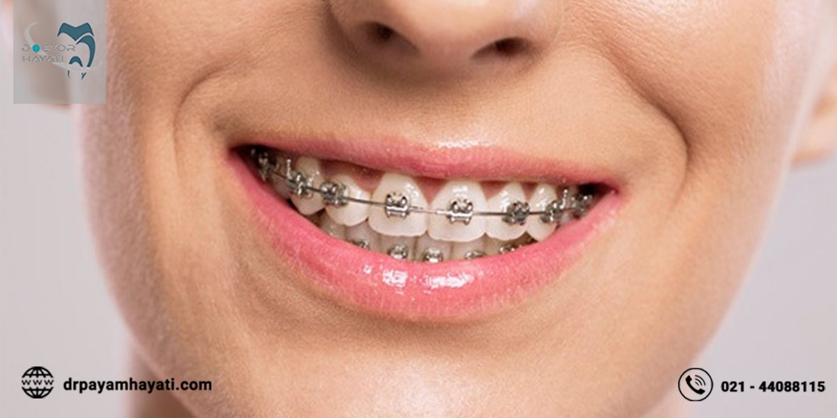 بایدها و نبایدهای مربوط به سیم کشی دندان که باید بدانید