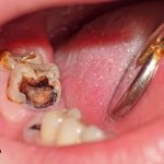 بررسی علل و عوامل سوراخ شدن دندان