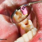 سوراخ شدن دندان چه علایم و نشانه هایی دارد ؟