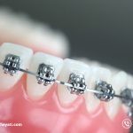 نکات طلایی مربوط به سیم کشی دندان که باید بدانید