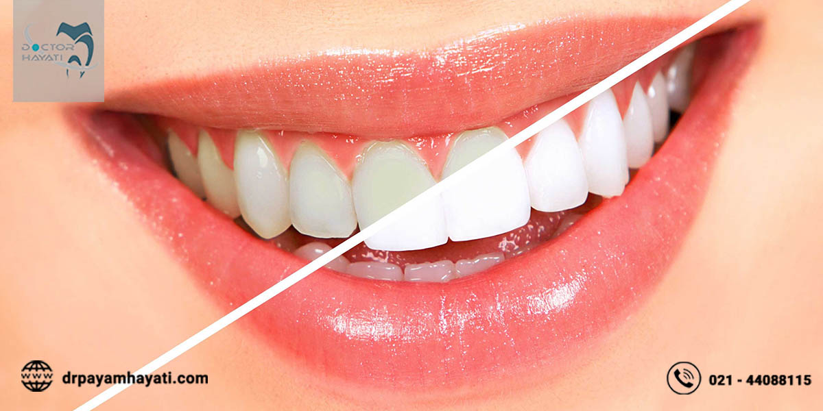 از لاک سفید کننده دندان چه اطلاعاتی دارید ؟