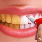 لاک سفید کننده دندان چه ویژگی هایی دارد ؟