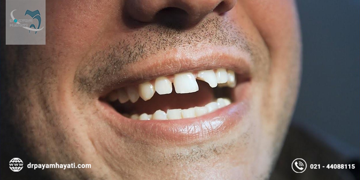 آیا میدانید ترمیم دندان شکسته چگونه است ؟