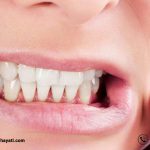 چه درمانی برای سایش دندان وجود دارد ؟
