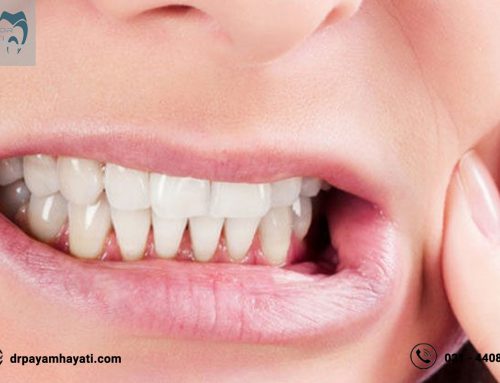 چه درمانی برای سایش دندان ها وجود دارد ؟