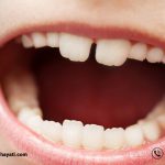 ماملون دندان چیست ؟