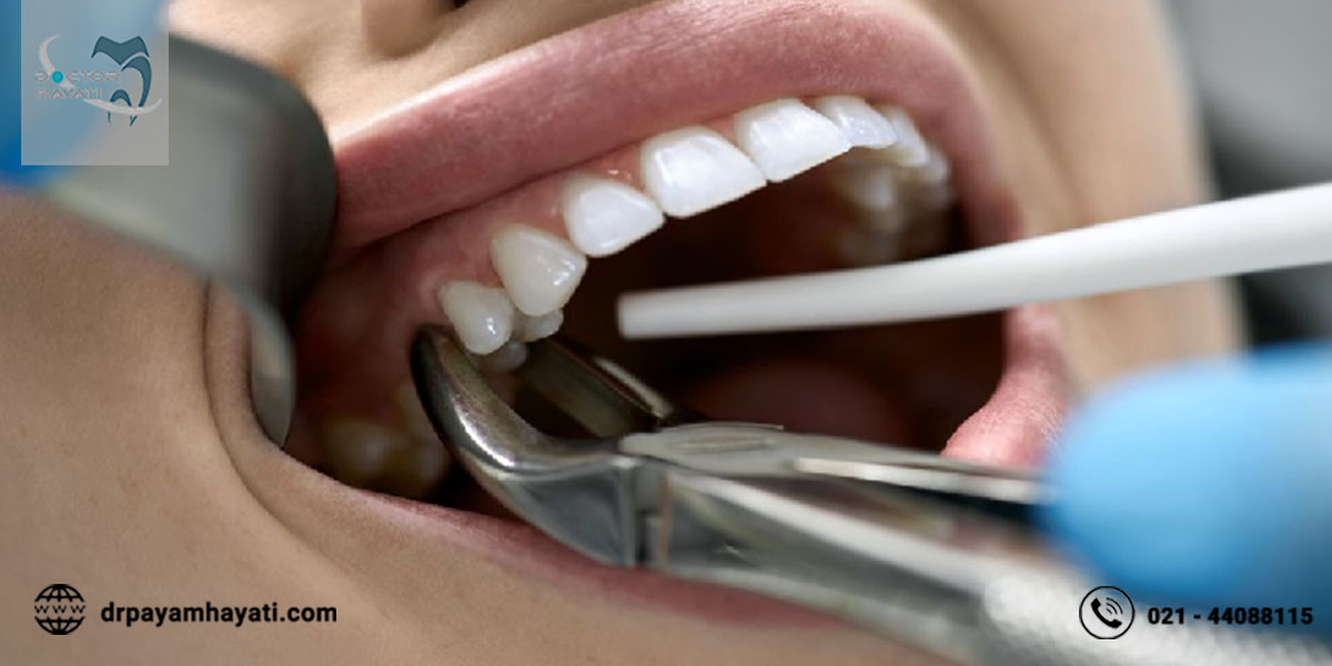 کشیدن دندان و ارتودنسی از جمله روش های درمان مزیودنس است