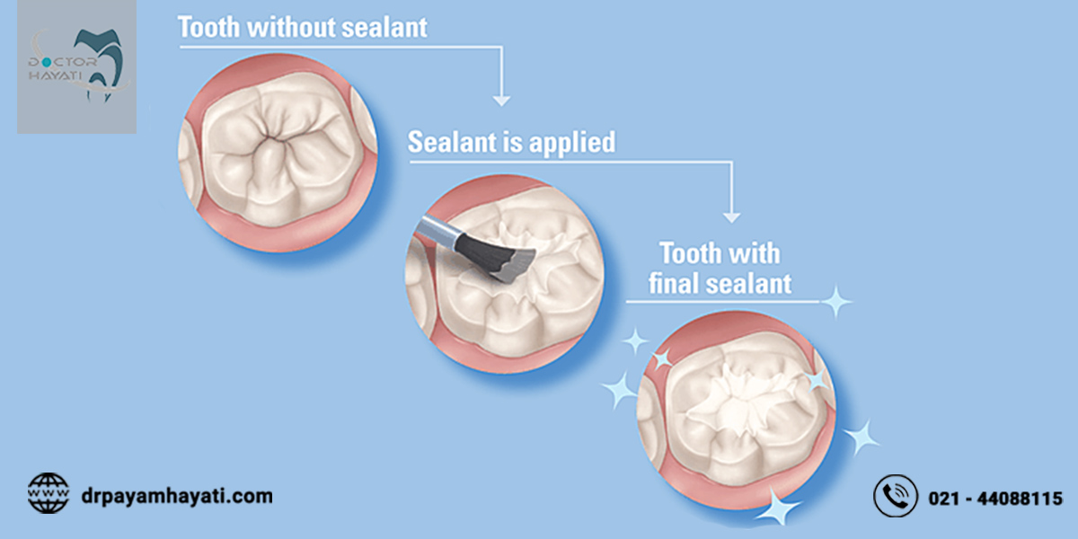 آیا میدانید که فیشور سیلانت یا شیار پوش روشی برای جلوگیری پوسیدگی دندان است