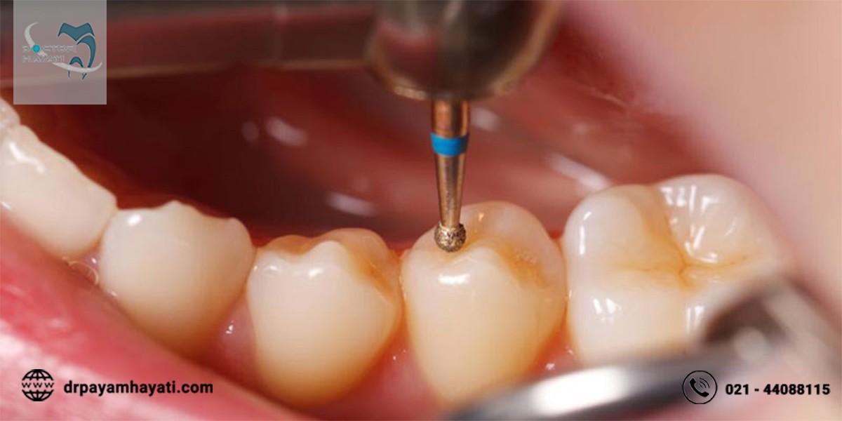 ویژگی های مهم پالپوتومی دندان شیری کودکان