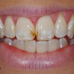 آیا برای لک دندان درمانی وجود دارد ؟