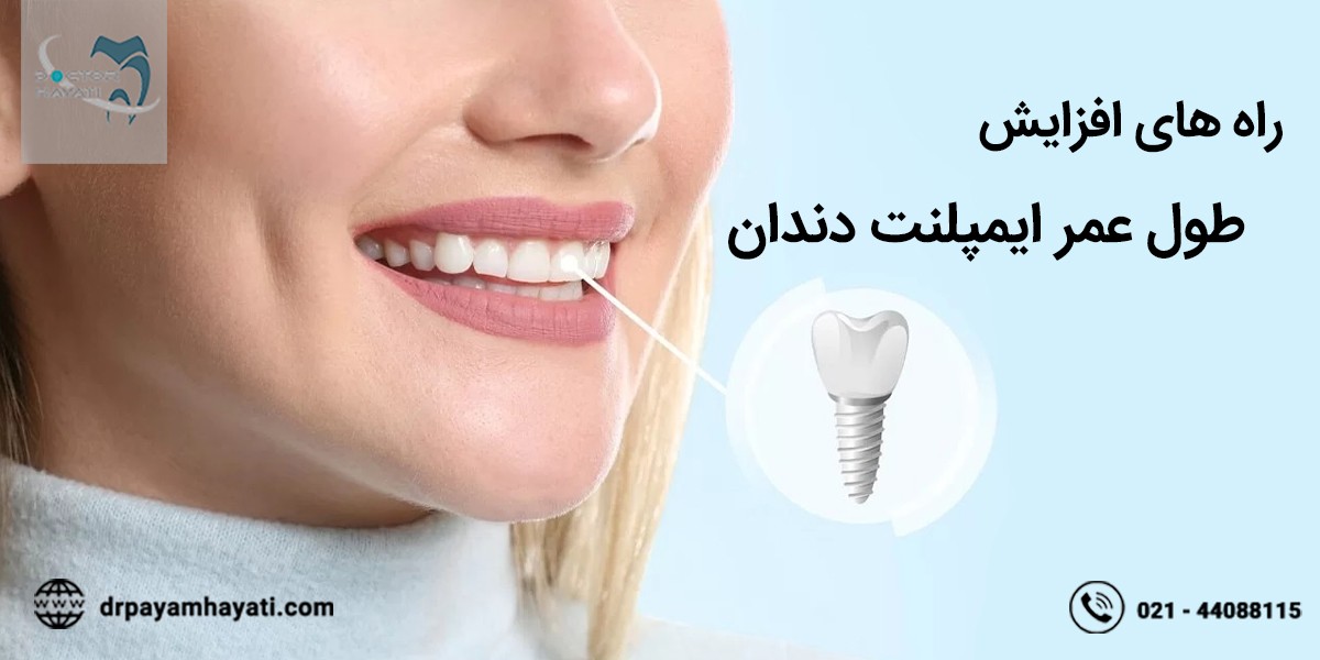 راه های افزایش طول عمر ایمپلنت دندان چیست ؟