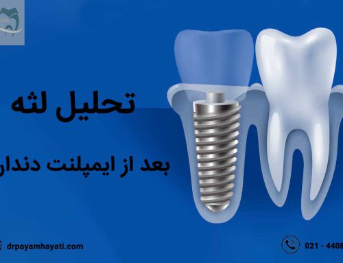 آیا میدانید علت تحلیل لثه بعد از ایمپلنت دندان چیست ؟
