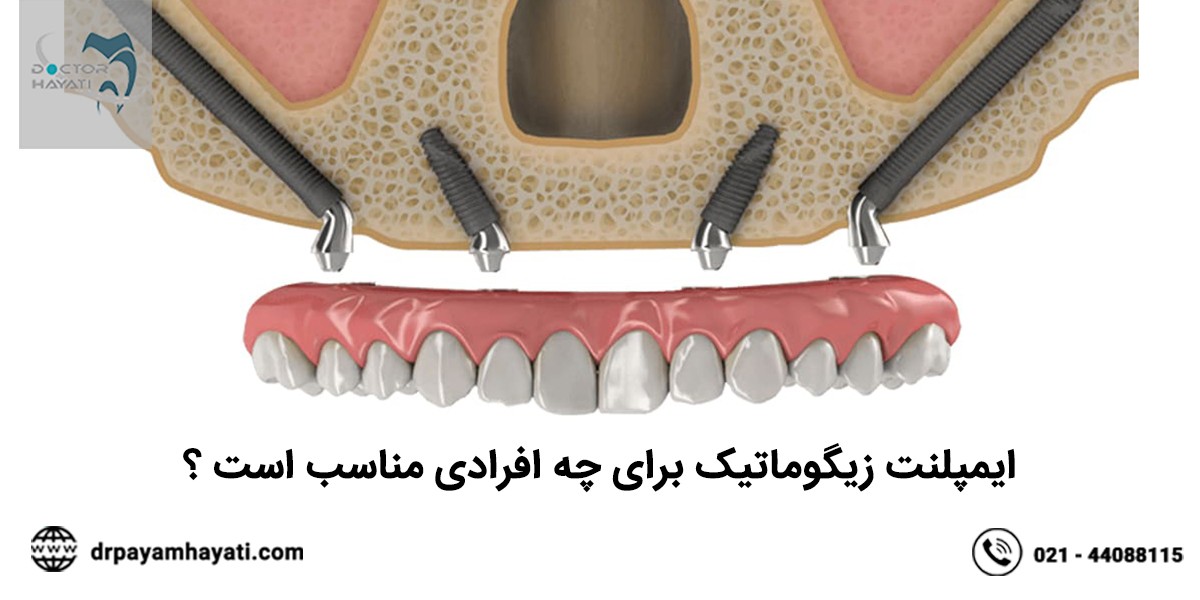 چه کسانی می‌توانند از ایمپلنت استفاده کنند؟ افرادی که یک یا چند دندان از دست‌رفته دارند، گزینه‌های مناسبی برای استفاده از ایمپلنت‌های دندانی هستند. در صورت از دست‌دادن دندان به دلایل زیر ممکن است به ایمپلنت دندان نیاز داشته باشید: حفره (پوسیدگی دندان). شکستگی ریشه دندان. دندان‌های از دست‌رفته مادرزادی. دندان قروچه (فشار دادن یا ساییدن دندان‌ها). بیماری لثه. آسیب صورت. ایمپلنت دندان بیماران دیابتی هم مقدور است اما باید از هفته‌ها پیش از عمل تحت نظارت پزشک قرار داشته باشند و مراقب مواردی مانند سطح گلوکز خونشان باشند. این دسته از افراد باید حتما زیر نظر پزشک، شرایطشان را مدام ارزیابی کنند. چه کسانی نمی‌توانند از ایمپلنت استفاده کنند؟ ممکن است که ایمپلنت دندان برای شما مناسب نباشد اگر: زیر ۱۸ سال هستید. (بیشتر جراحان در این سن بیماران برای آنها ایمپلنت دندان قرار نمی‌دهند مگراینکه رشد فک متوقف شده باشد.) سیگار می‌کشید یا از محصولات تنباکو استفاده می‌کنید. بخش قابل‌توجهی از استخوان فک را از دست داده‌اید. بهداشت دهان و دندانتان ضعیف و نامناسب باشد. ایمپلنت دندان پوسیده مقدور نیست. بیماری لثه فعال یا درمان‌نشده داشته باشید. بیماری‌های خاصی مانند اختلالات استخوانی یا بیماری‌های خودایمنی داشته باشید.