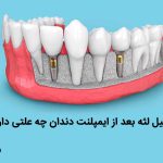 تحلیل لثه بعد از ایمپلنت دندان چه علتی دارد ؟